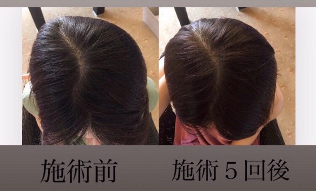 頭の形矯正